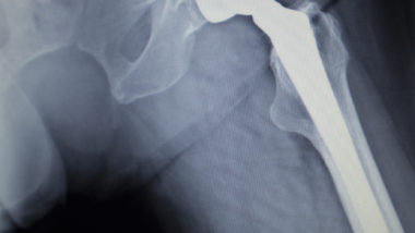 The claims period in the Stryker implants class action settlement opened on March 30, 2020 entitling those who were implanted with an allegedly defective hip implant system potentially thousands of dollars in awards.