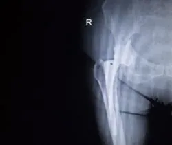 Hip implant X-ray regarding the Wright Profemur Hip Implant Class Action Settlement rescheduled